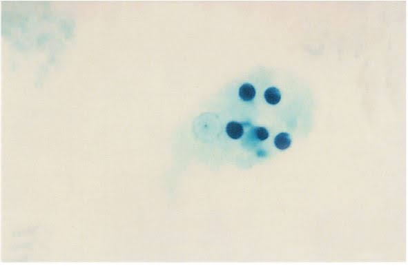 Trophozoite of  Entamoeba histolytica