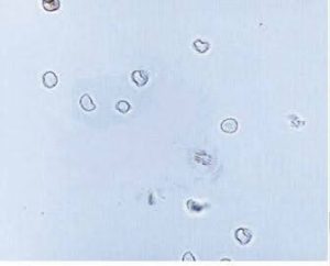 Microscopic analysis of urine sediment » Clinical Laboratory Science