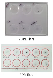 VDRL and RPR antibody titers used to monitor syphilis treatment response