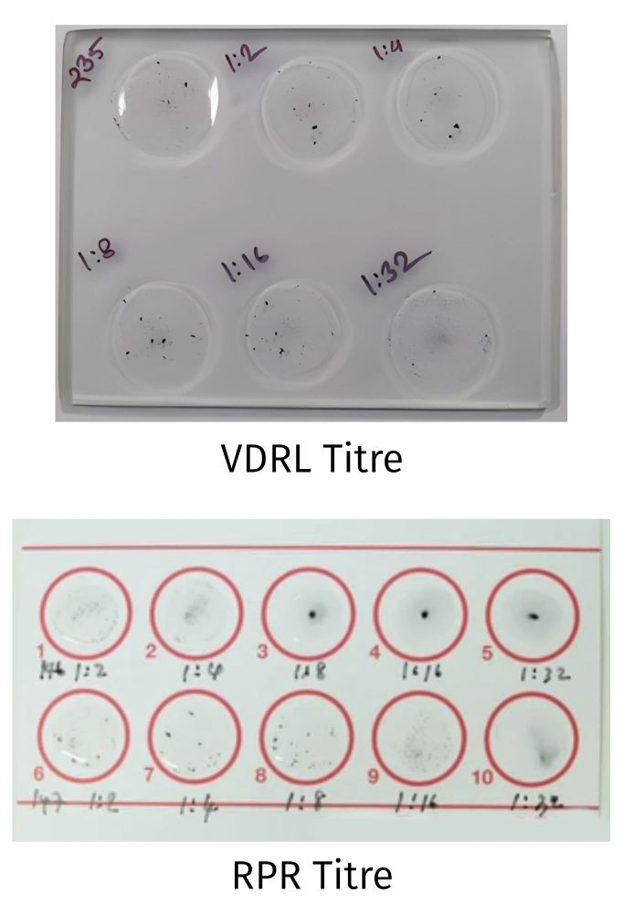 VDRL and RPR antibody titers used to monitor syphilis treatment response