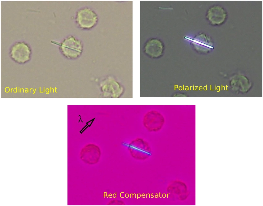 MSU crystals in a synovial fluid